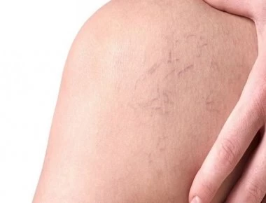 Φλεβίτιδα: Αίτια και συμπτώματα